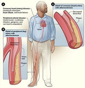 atherosclerosis