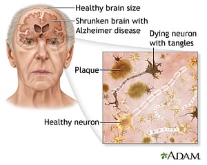 Alzheimer